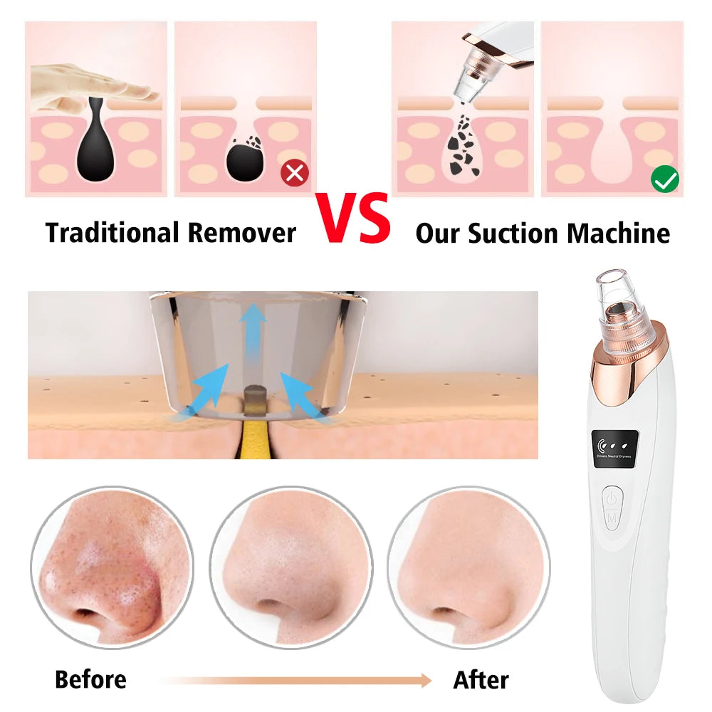 Electric Blackhead Remover Device