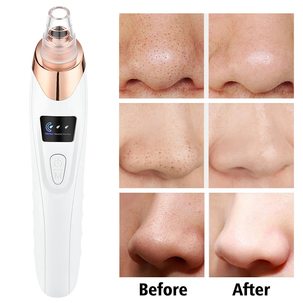 Electric Blackhead Remover Device